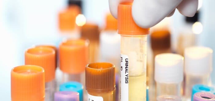 أسباب تستدعي إجراء تحليل مزرعة البول أو البراز