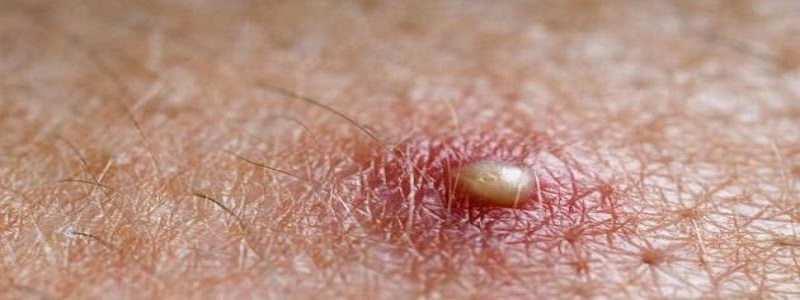 أفضل مضاد حيوي لعلاج الخراج في المؤخرة