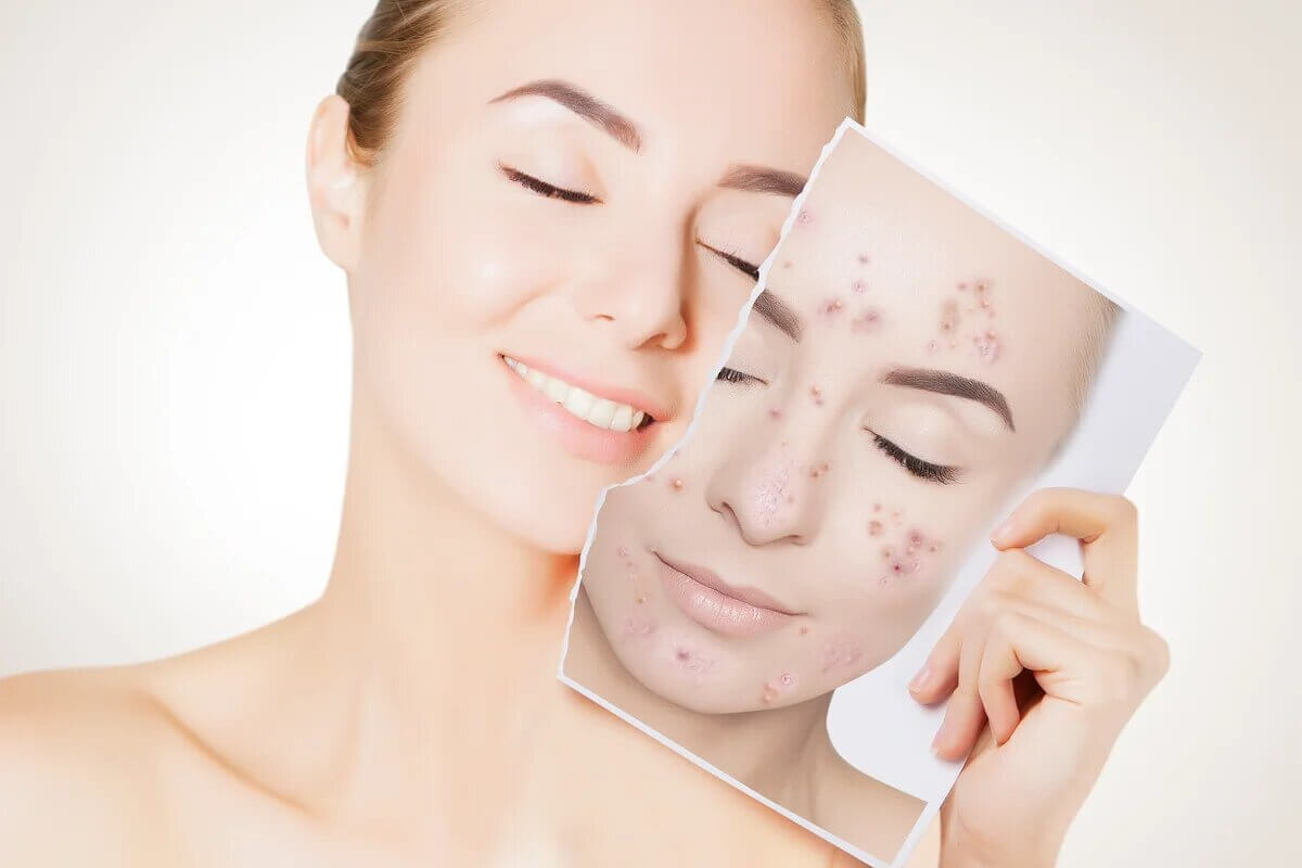 محلول حب الشباب ديرما ت Derma T الحل الأمثل للقضاء على حب الشباب